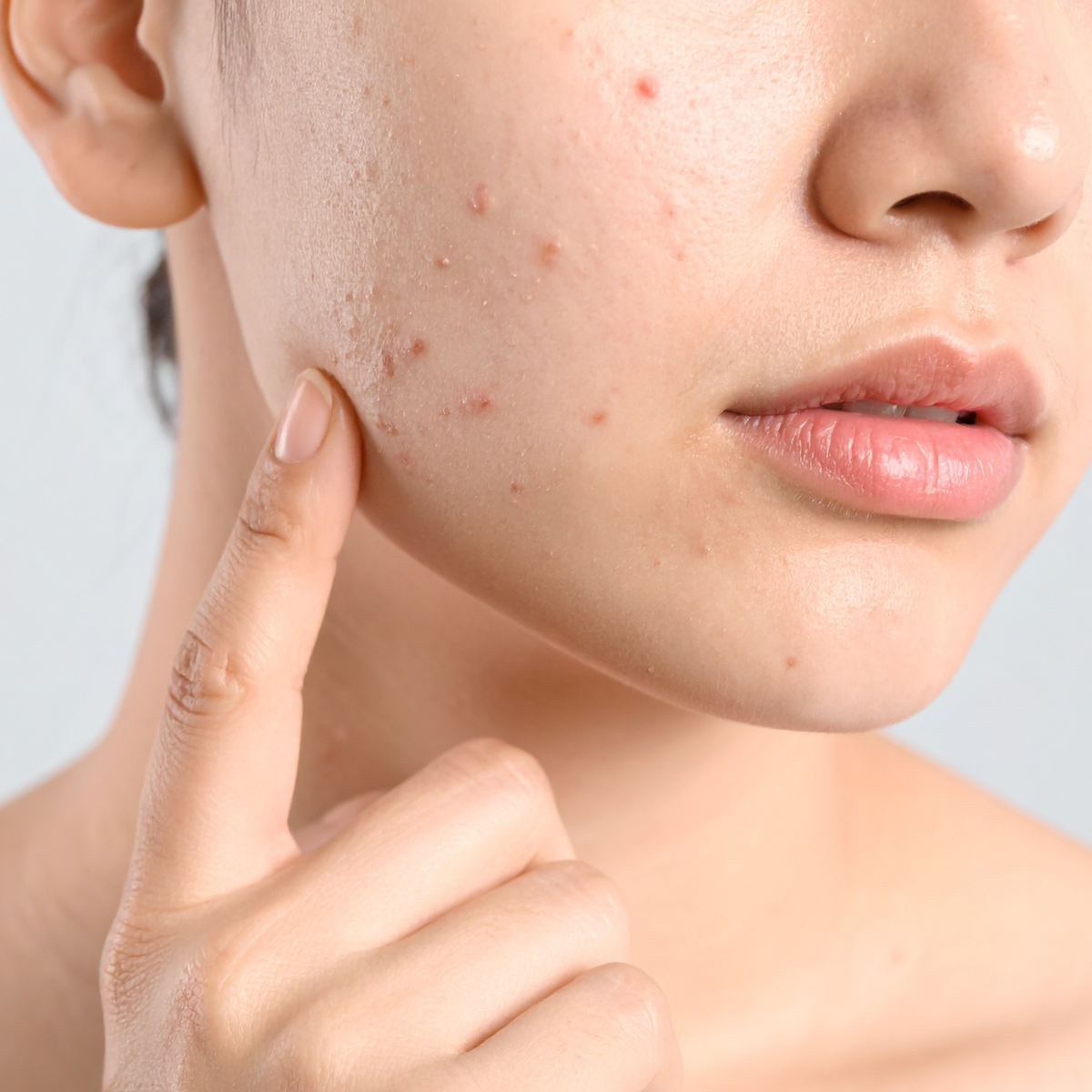 Advanced Strategies for Moderate to Severe Acne: Navigating Combinatio ...